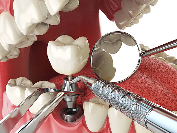 Best Broken or Cracked Tooth Emergency Dentist in La Luz, NM